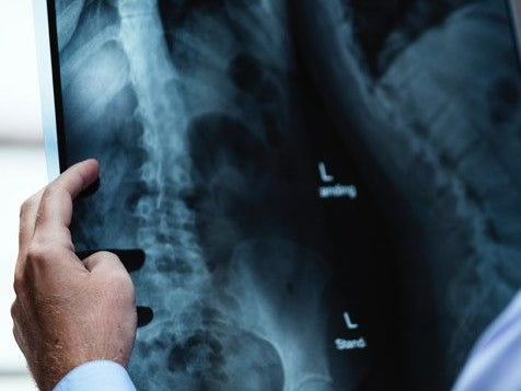 Fosamax and Actonel Not the Answer for Bones