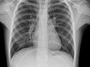 Statins Increase the Risk for Pneumonia