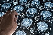 High Cholesterol in Middle Age Linked to Future Alzheimer's Risk